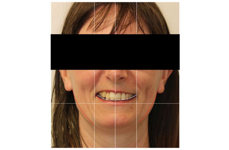 Digital Smile Design Treatment in Melbourne by Healthy Smiles