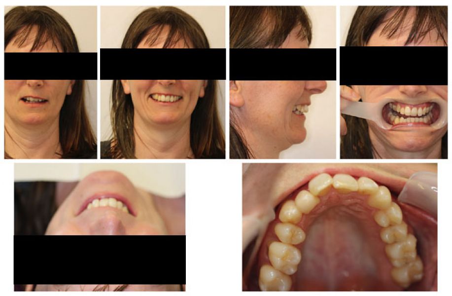 Digital Smile Design Treatment in Melbourne by Healthy Smiles