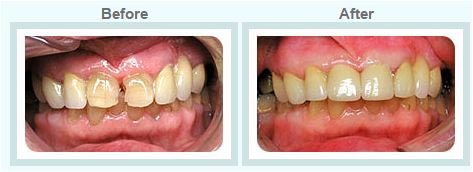 Porcelain Crowns and Veneers Treatment by Healthy Smiles 