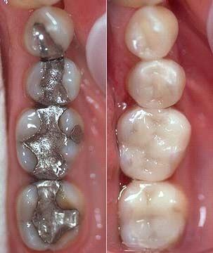 Single Visit CEREC Porcelain Restoration - Ashton Avenue Dental Clinics