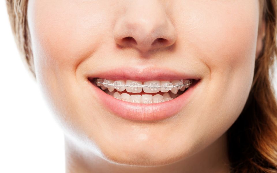 Clear Invisible Braces Gold Coast  