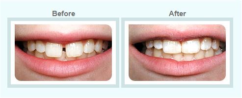 Smile Designing and Smile Makeover Treatment by Healthy Smiles