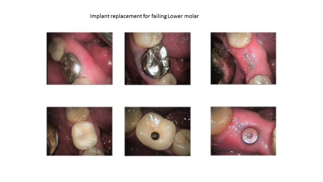 Dental Implant Treatment - Affordable Way to Replace a Missing Tooth