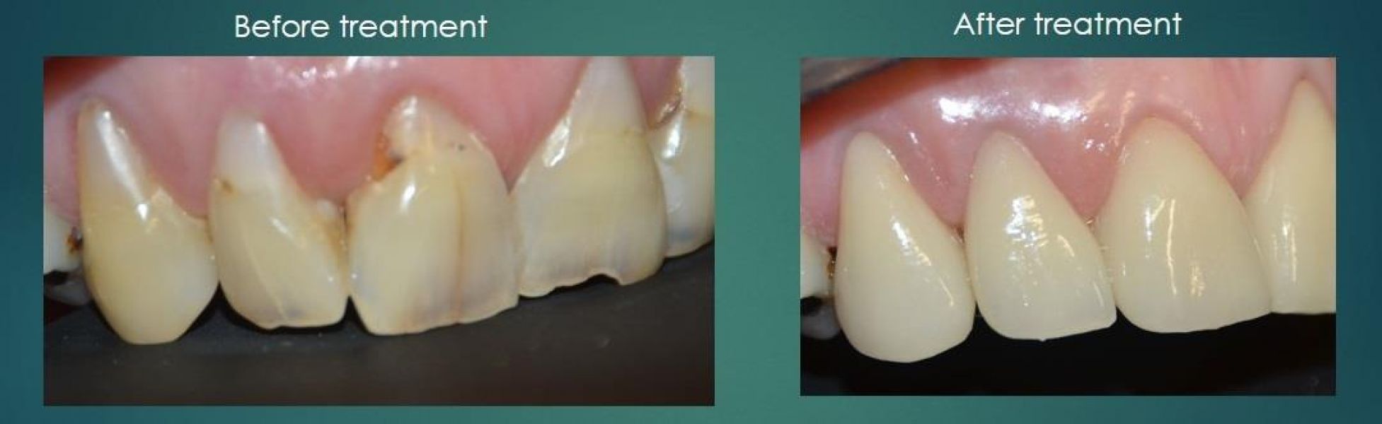 Smile Designing Makeover - Smile Dentist Claremont Australia