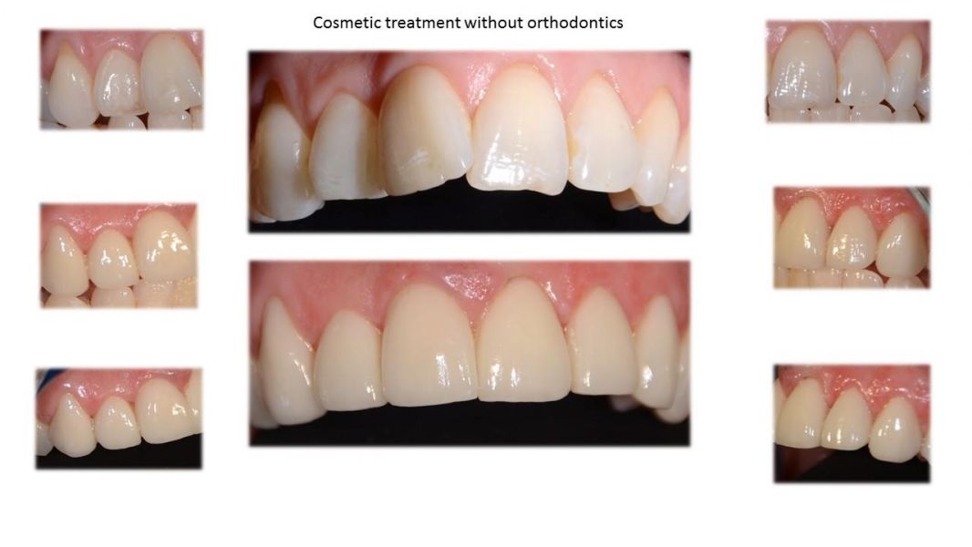 Dental Implant Treatment - Affordable Way to Replace a Missing Tooth