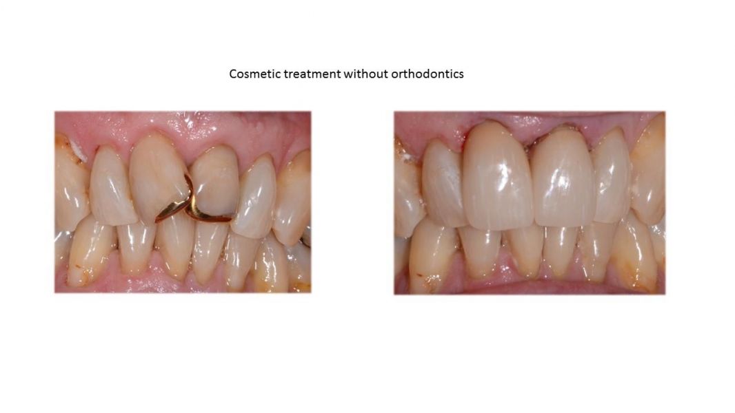 Mouth Guard Sports – Dental Mouth Guards at Ashton Dental clinic, Claremont