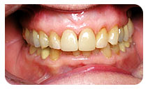 Porcelain Crowns and Veneers Treatment by Healthy Smiles 