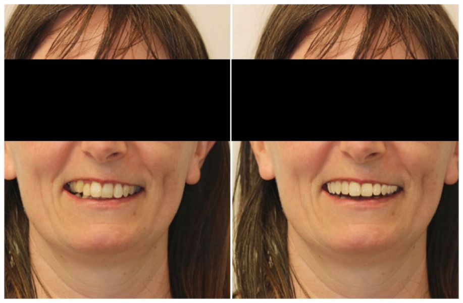 Digital Smile Design Treatment in Melbourne by Healthy Smiles
