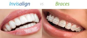 Invisalign Braces - Invisalign Orthodontics Treatment Blackburn | Healthy Smiles 